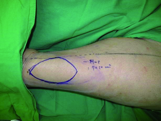 使用前外側大腿肌皮瓣重建坐骨處壓瘡傷口之示意圖02